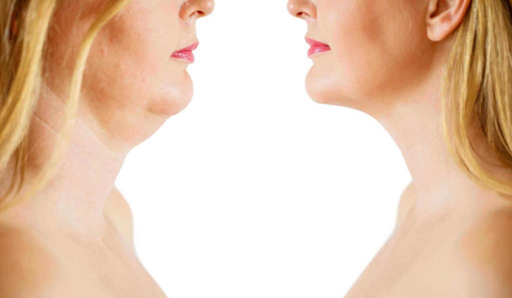 Double Chin treatment Greater London (Richmond upon Thames) before and after results