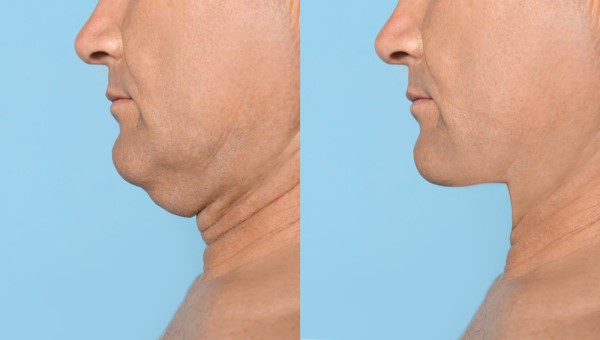 Which Non-Surgical Treatments Work Best for Jowls and Loose Skin Greater London (Richmond upon Thames)?