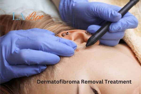 Dermatofibroma Removal Treatment Greater London (Richmond upon Thames)