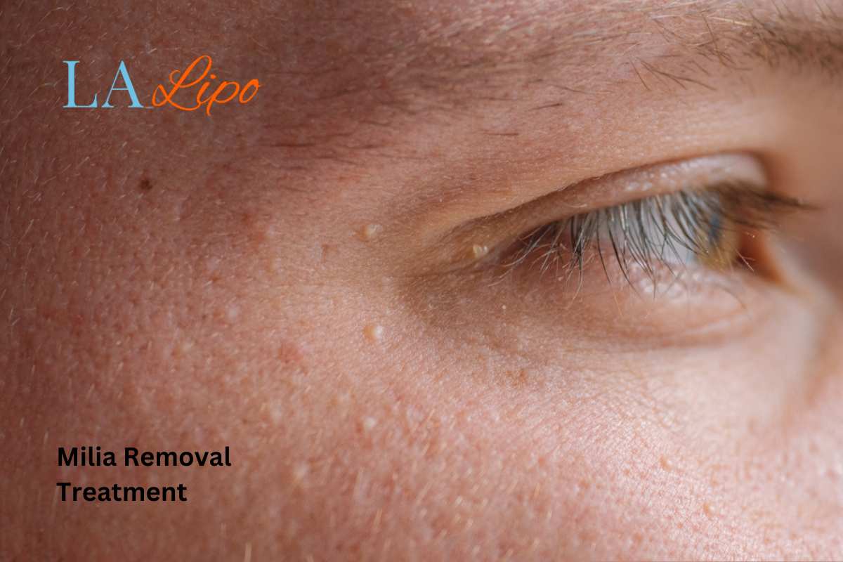 Cryopen Milia Removal: Is It the Easiest and Safest Option Greater London (Richmond upon Thames)?