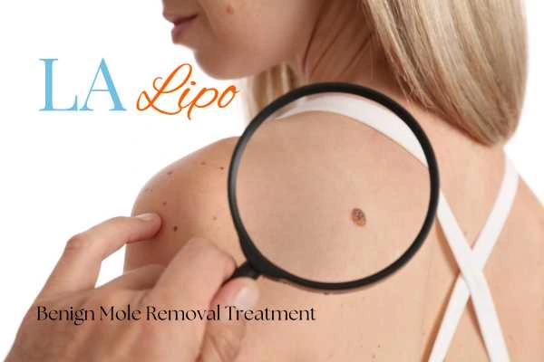Woman having her inspection of blemish before mole removal Greater London (Richmond upon Thames)