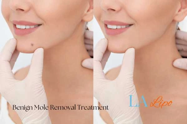 Before and after mole removal Greater London (Richmond upon Thames) treatment
