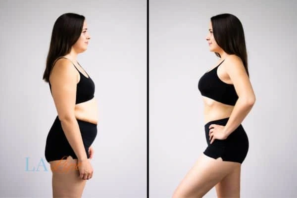 image of woman before and after results of LA-EMS Body Sculpting Greater London (Richmond upon Thames) to help treat Diastasis recti