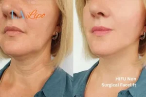 hi-fu for wrinkles Greater London (Richmond upon Thames) before and after results