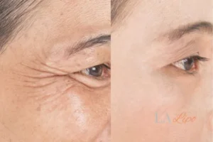 Before and after results of woman - HI-fu wrinkles reduction treatment Greater London (Richmond upon Thames)