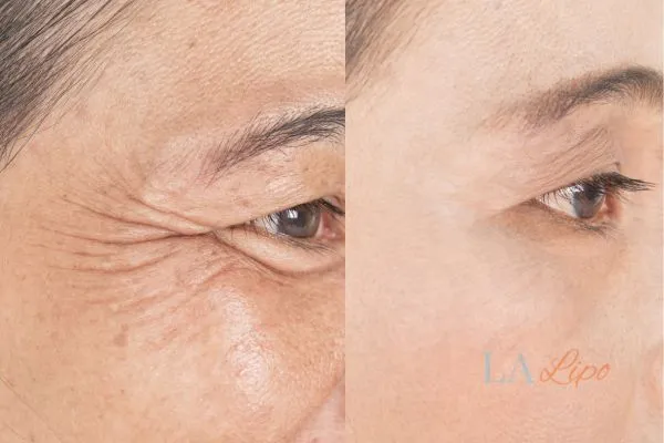 Before and after results of woman - HI-fu wrinkles reduction treatment Greater London (Richmond upon Thames)