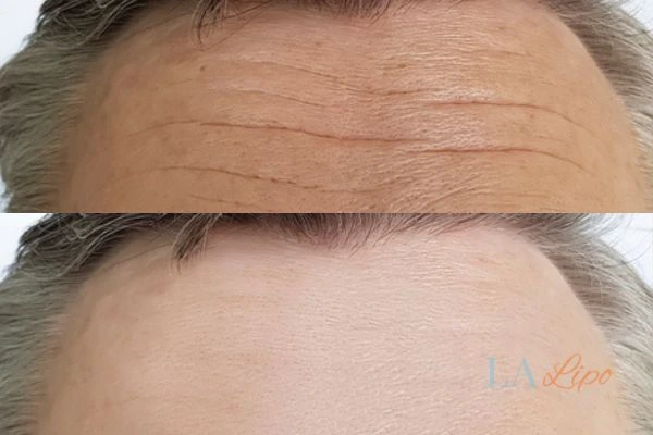 results of HIFU Greater London (Richmond upon Thames) on mans forehead to help reduce lines and wrinkles