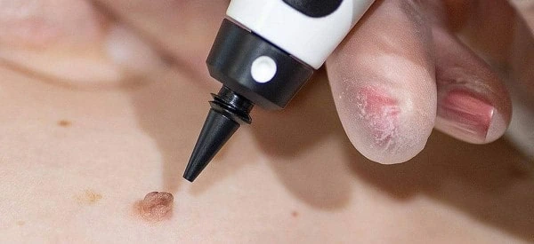 skin tag removal using cryopen Greater London (Richmond upon Thames)
