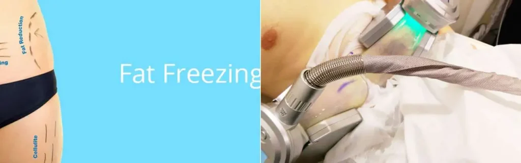 Fat freezing Greater London (Richmond upon Thames) on multiple areas of the body