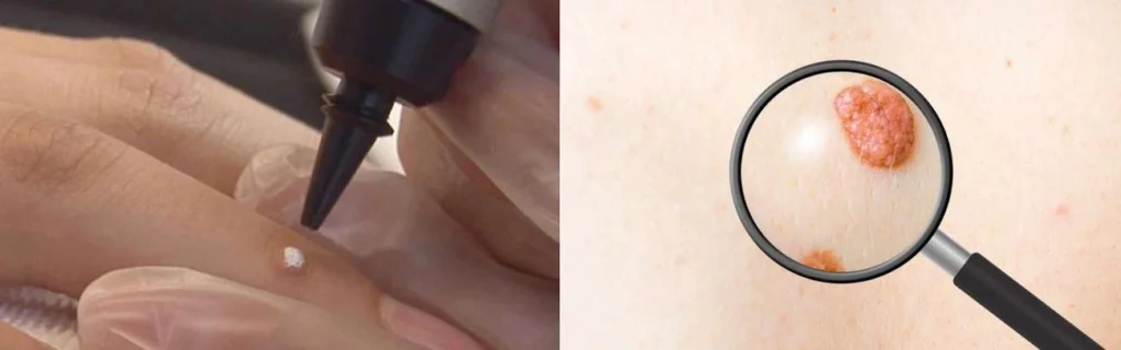 Person getting moles removed with cryopen Greater London (Richmond upon Thames)