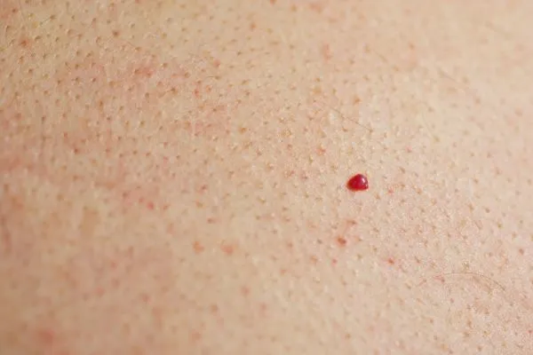 close up of a cherry angioma Greater London (Richmond upon Thames)