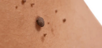 image of a skin tag Greater London (Richmond upon Thames)