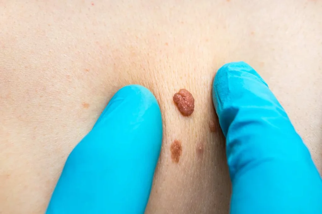 Consultant examining a skin tag Greater London (Richmond upon Thames)