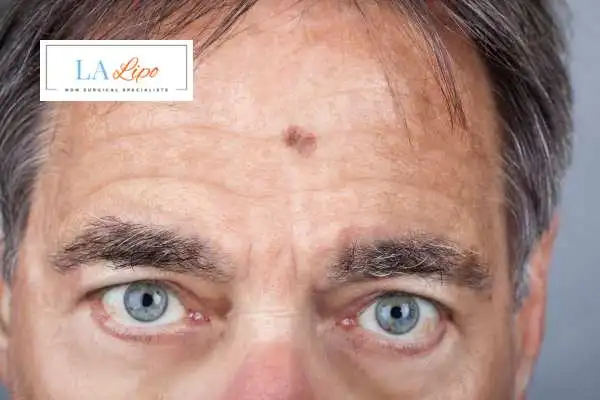 Solar Lentigo Removal Greater London (Richmond upon Thames) image of man with mark on his forehead