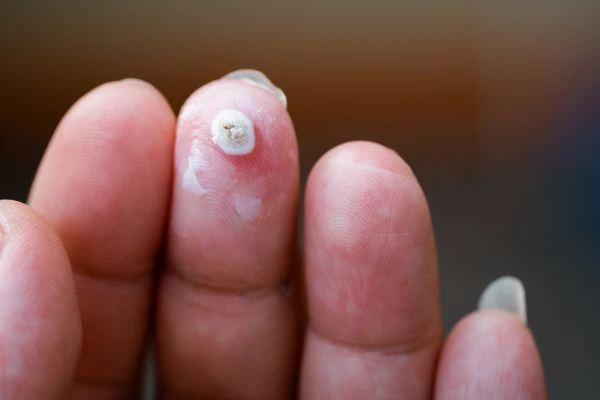 wart on person finger - cryotherapy to treat from LA LIPO Greater London (Richmond upon Thames)