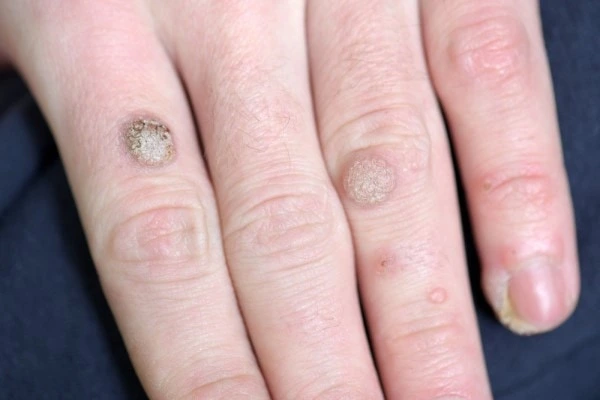 photo of warts on person hand - see wart removal Greater London (Richmond upon Thames) from LA LIPO
