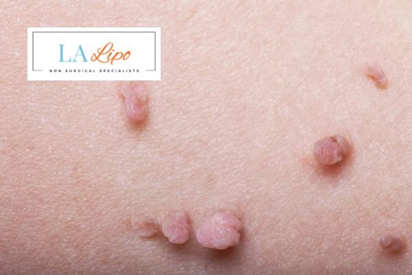 Does cryopen skin tag removal Greater London (Richmond upon Thames) hurt? Find out now call our team today!