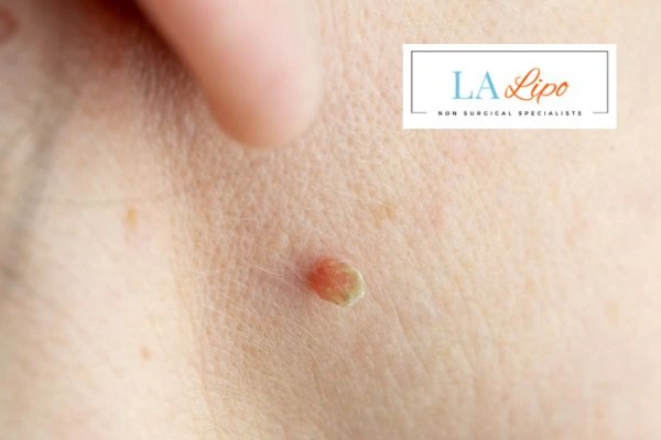 Book skin tag removal Greater London (Richmond upon Thames) today speak to our team now!