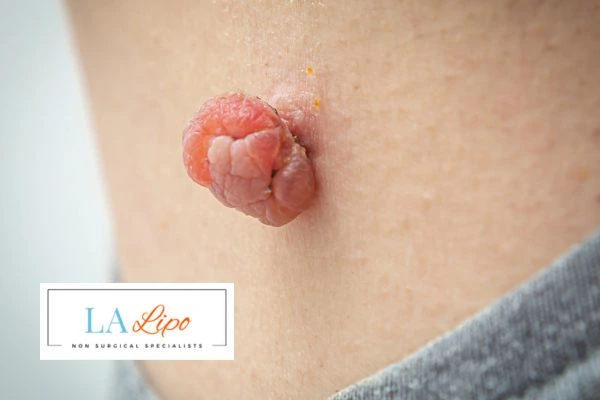 Interested in skin tag removal Greater London (Richmond upon Thames)? Concerned about the pain? Find out more today!