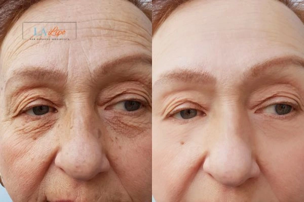 The powerful benefits of Morpheus8 Treatment Greater London (Richmond upon Thames) - Call Our team today!