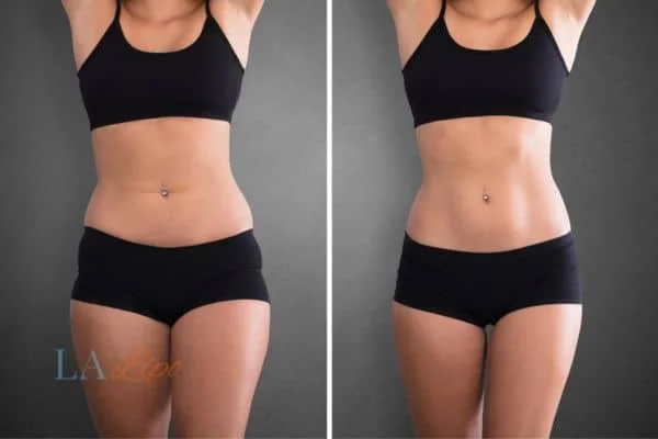 before and after results of non-surgical treatment to help a woman's body image and mental health Greater London (Richmond upon Thames)
