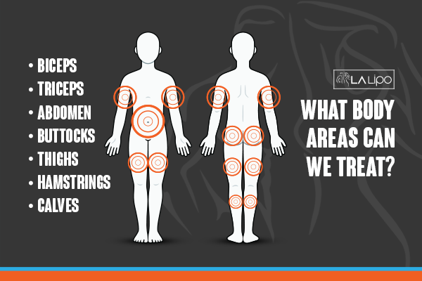 Diagram to show areas you can have LA-EMS Body Sculpting Treatment Greater London (Richmond upon Thames)