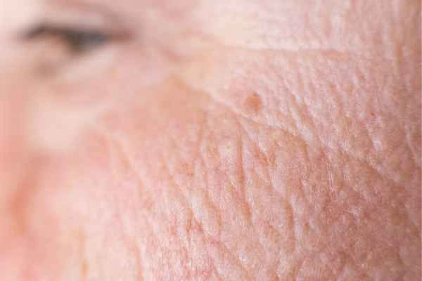 close up picture of a woman's face showing an age spot Greater London (Richmond upon Thames)