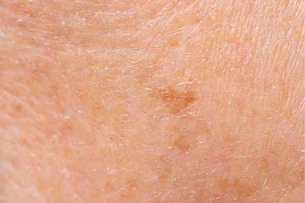 close up picture of age spots Greater London (Richmond upon Thames)