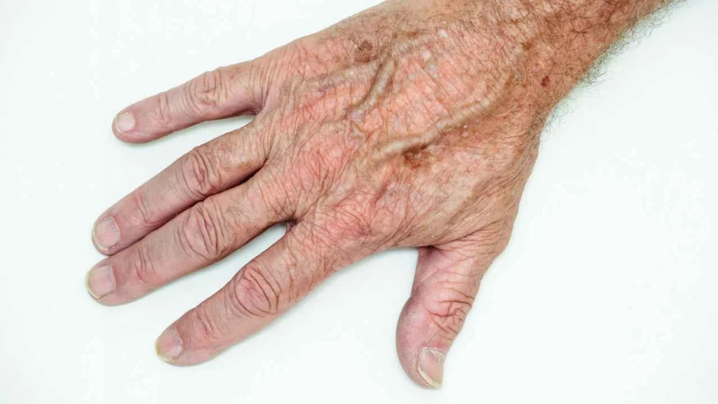 Male hand showing age spot Greater London (Richmond upon Thames)