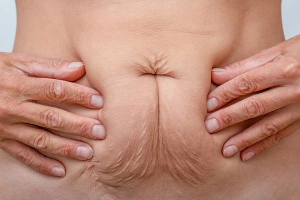 Image of a woman's stomach with loose skin - example of skin tightening Greater London (Richmond upon Thames) options