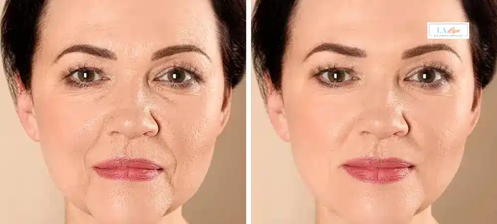 How Long Does It Take to See Results and How Long Do They Last Greater London (Richmond upon Thames)?