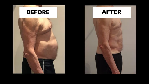 What Symptoms Can Diastasis Recti Cause in Men? Weak Core, Back Pain and Poor Posture Greater London (Richmond upon Thames)